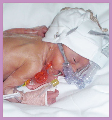 Photo of premature child in incubator with breathing aparatus.