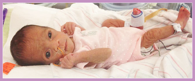 Photo of premature child depicting premature skin.