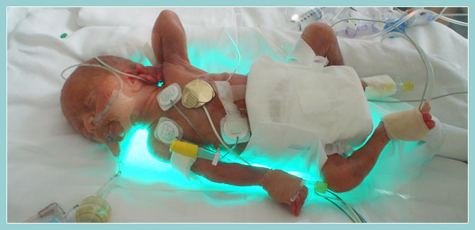 Photo of a preterm child in an incubator.